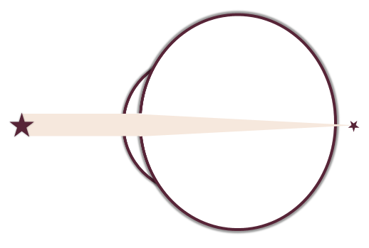 Schema hypermétropie